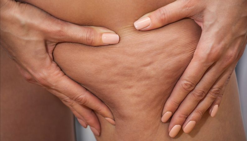 come trattare la cellulite