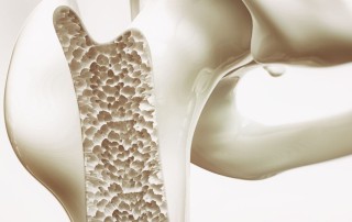 Osteoporosi: come riconoscerla, accettarla e trattarla