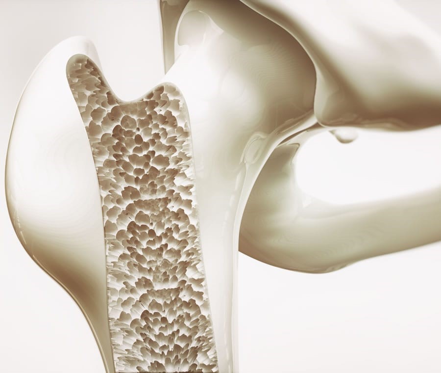Osteoporosi: come riconoscerla, accettarla e trattarla