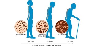 Osteoporosi: come riconoscerla, accettarla e trattarla