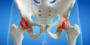Osteoporosi: come riconoscerla, accettarla e trattarla
