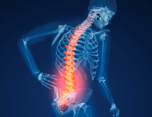 Osteoporosi: come riconoscerla, accettarla e trattarla