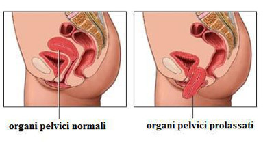 Cosa sono i prolassi urogenitali nella donna